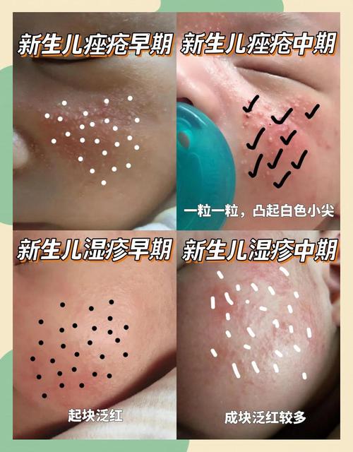 新生儿湿疹和痤疮区别-第3张图片-郑州医学网