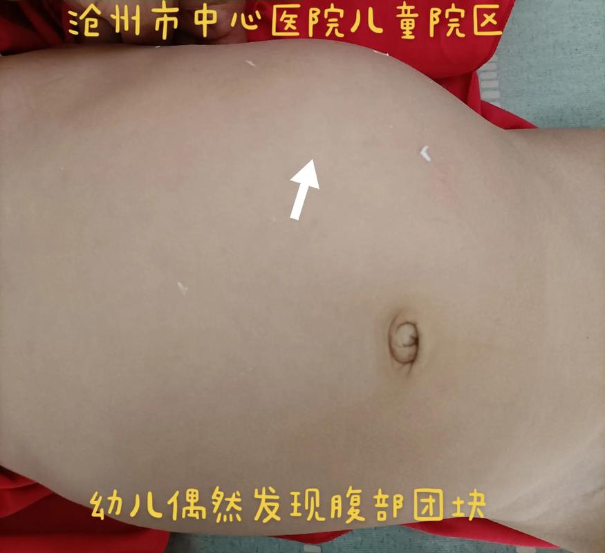 新生儿肾上腺母细胞瘤早期症状隐匿，家长该如何识别与应对？-第1张图片-郑州医学网