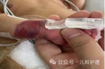 新生儿肾上腺母细胞瘤早期症状隐匿，家长该如何识别与应对？-第3张图片-郑州医学网