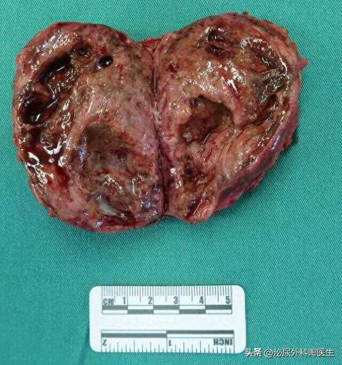 新生儿肾上腺母细胞瘤早期症状隐匿，家长该如何识别与应对？-第2张图片-郑州医学网