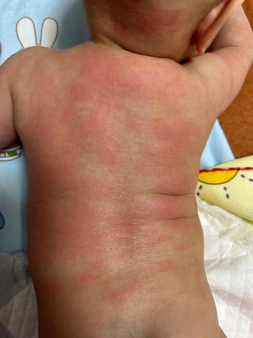 三岁儿童身上突然起红疙瘩，是过敏、湿疹还是其他问题？-第2张图片-郑州医学网