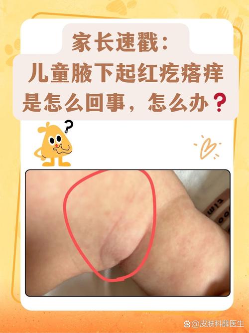 三岁儿童身上突然起红疙瘩，是过敏、湿疹还是其他问题？-第3张图片-郑州医学网
