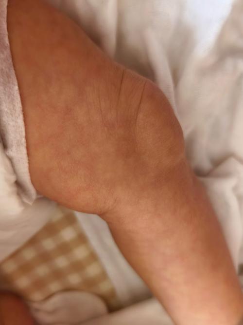 新生儿金色葡萄菌感染-第1张图片-郑州医学网