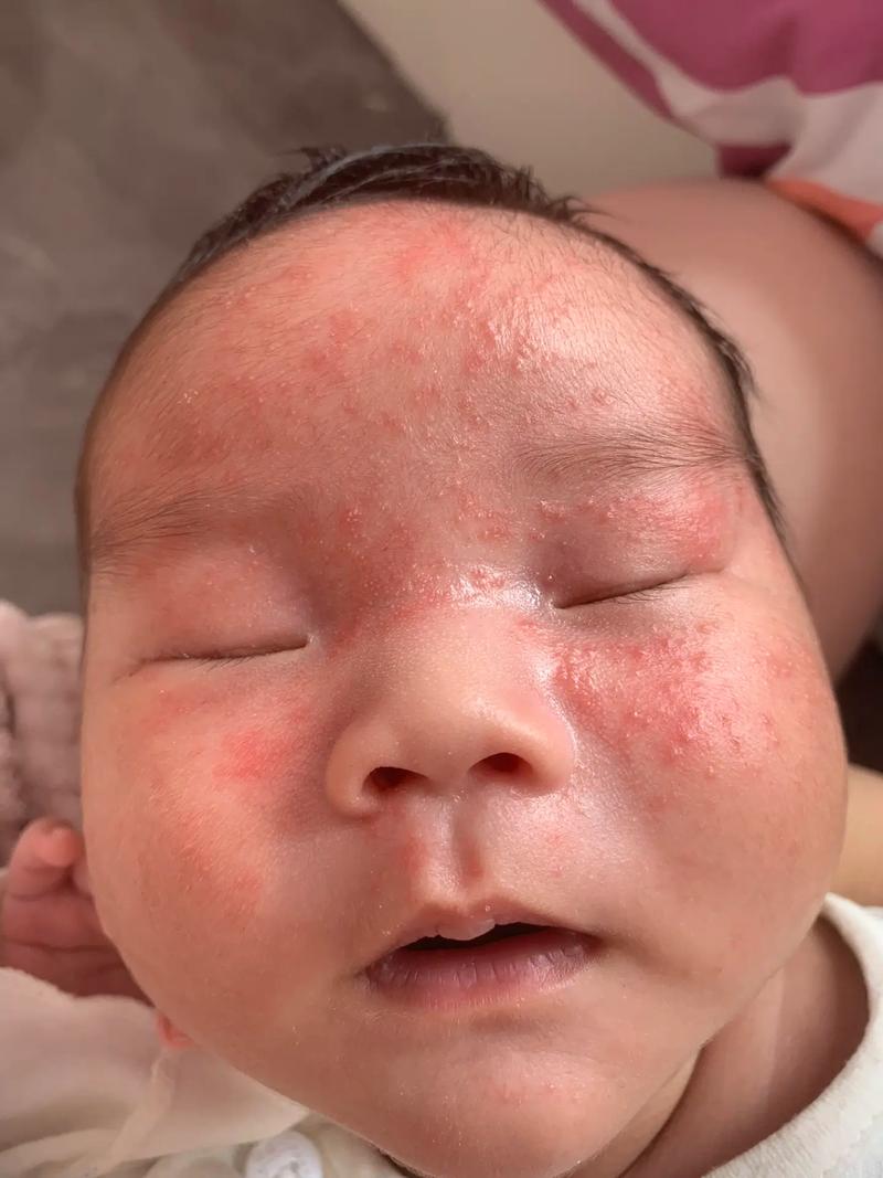 新生儿金色葡萄菌感染-第2张图片-郑州医学网