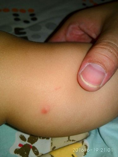 新生儿腿上有个大疙瘩-第3张图片-郑州医学网
