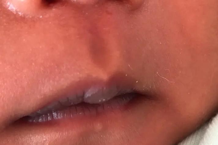 新生儿嘴唇上有红色的是怎么回事？需要担心吗？-第3张图片-郑州医学网