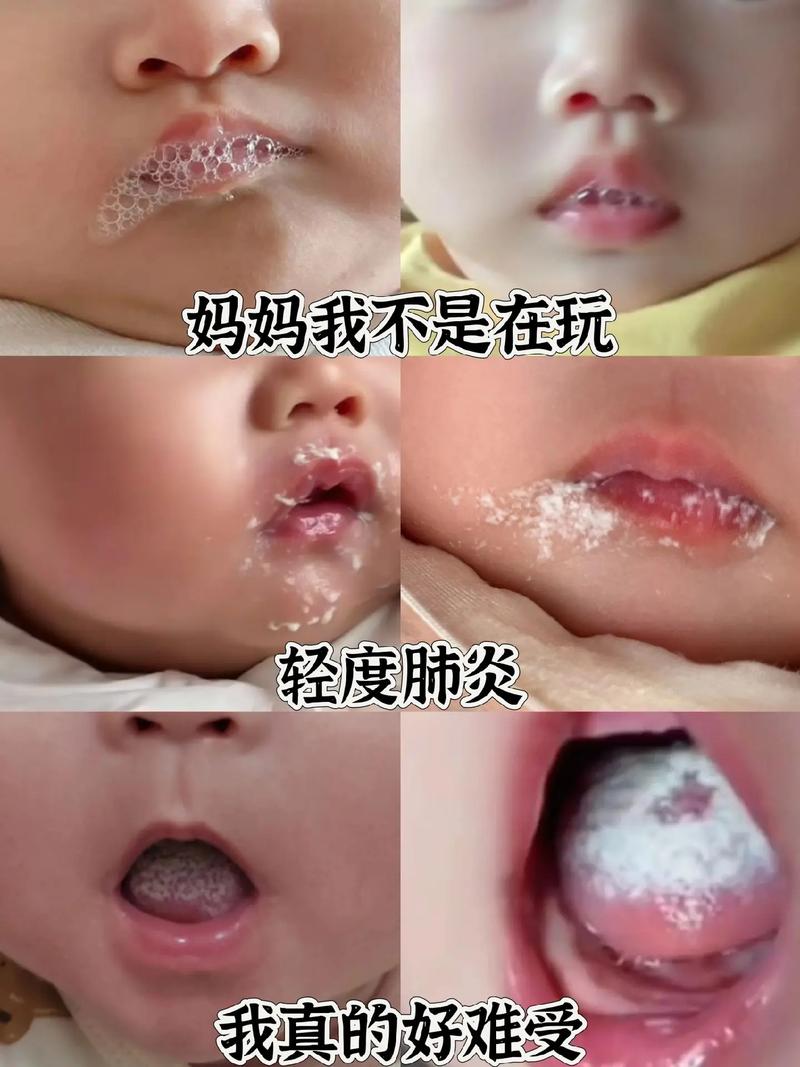 新生儿肺炎严重的症状-第3张图片-郑州医学网