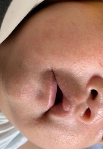 新生儿奶粉上火的症状-第3张图片-郑州医学网 新生儿奶粉上火的症状-第3张图片-郑州医学网