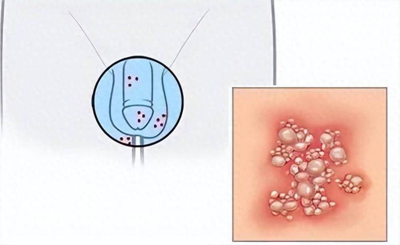 儿童生殖器湿疹怎么办？日常护理与用药有哪些注意事项？-第2张图片-郑州医学网