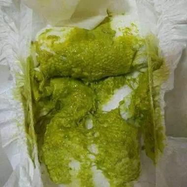 新生儿拉绿色大便 稀-第2张图片-郑州医学网