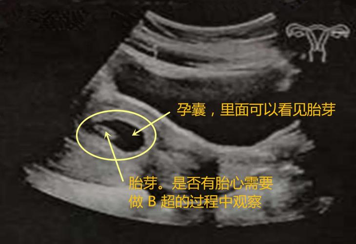 孕期男女宝宝b超图片-第1张图片-郑州医学网