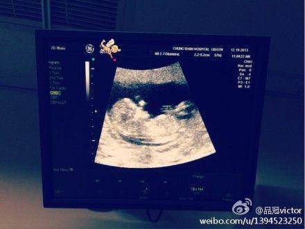 孕期男女宝宝b超图片-第3张图片-郑州医学网