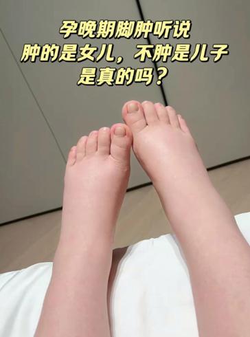 孕期不浮肿是男孩女孩-第2张图片-郑州医学网