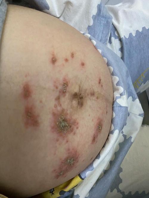 孕期病毒感染什么症状-第2张图片-郑州医学网