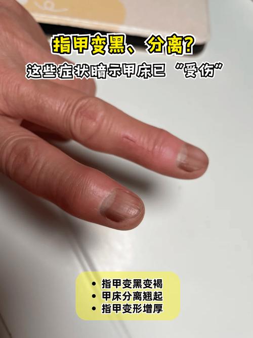 孕期指甲变黑是身体异常信号吗？需要警惕哪些健康问题？-第1张图片-郑州医学网