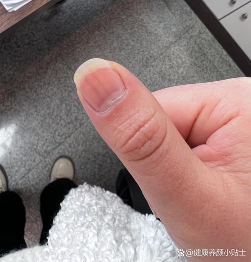 孕期指甲变黑是身体异常信号吗？需要警惕哪些健康问题？-第2张图片-郑州医学网