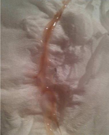 孕期大便时白带有血丝-第2张图片-郑州医学网