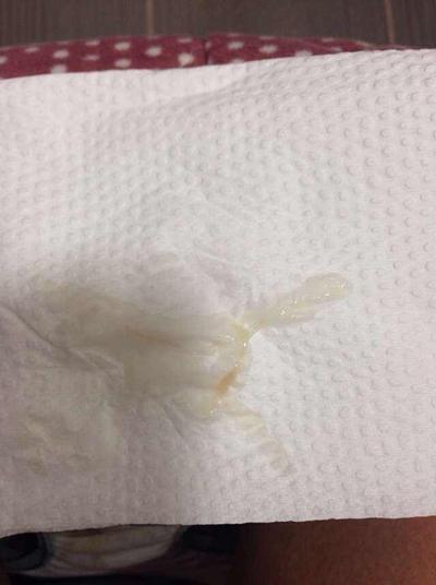 孕期大便时白带有血丝-第3张图片-郑州医学网
