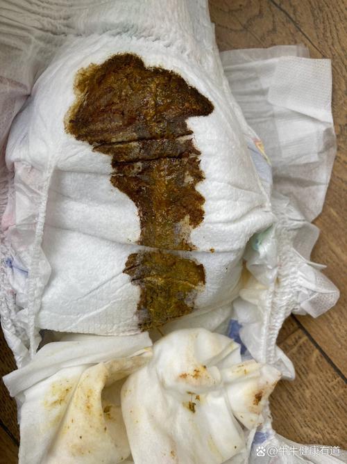 新生儿 大便少量血丝-第2张图片-郑州医学网