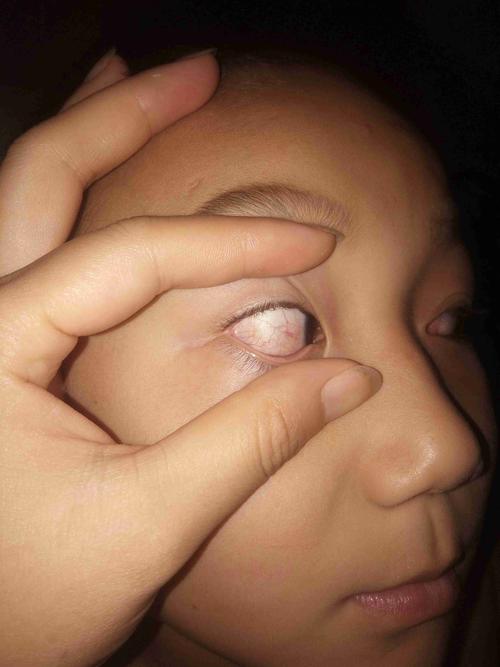 8岁儿童眼睛有红血丝-第1张图片-郑州医学网