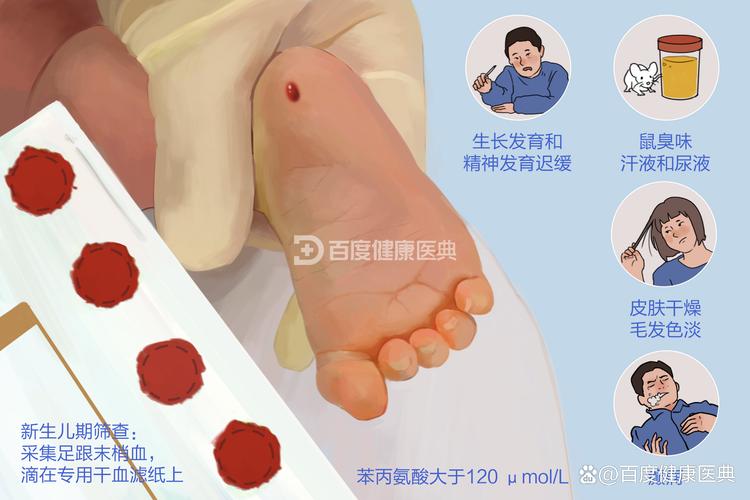 新生儿筛查苯丙酮尿症，早发现早干预能避免哪些严重后果？-第3张图片-郑州医学网
