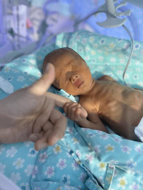 21三体综合症新生儿-第3张图片-郑州医学网