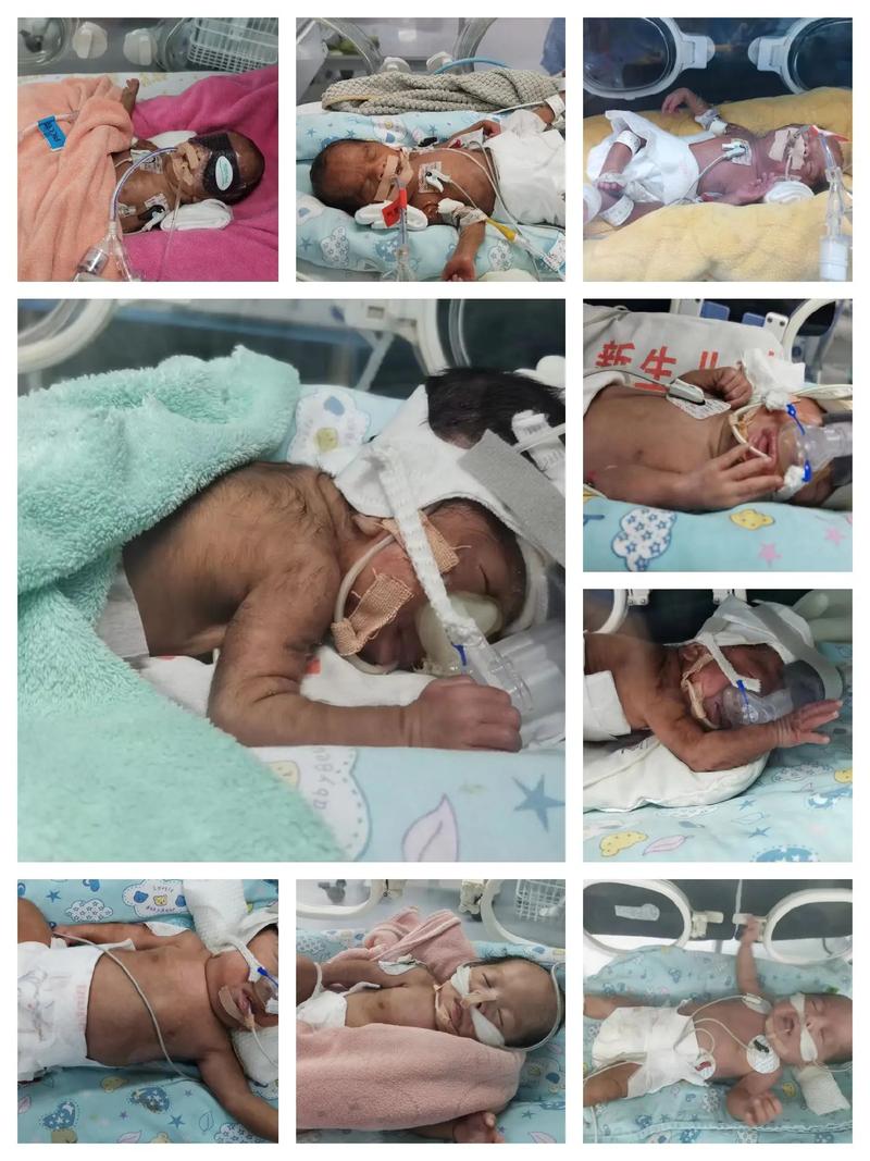 21三体综合症新生儿-第2张图片-郑州医学网