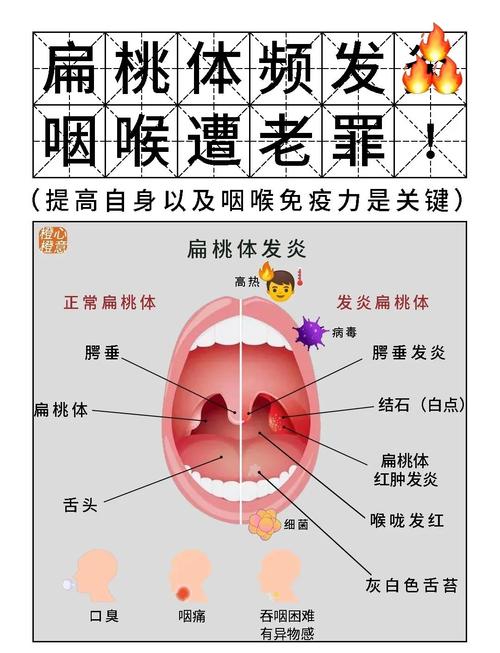 儿童扁桃体炎治疗方法-第1张图片-郑州医学网