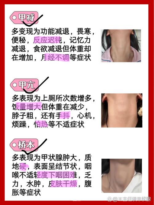 孕期甲状腺筛查异常，身体出现哪些症状需警惕？-第1张图片-郑州医学网