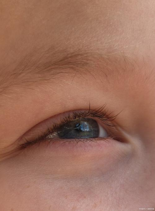 儿童眼肿早期肾病征兆-第2张图片-郑州医学网