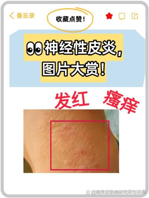 儿童神经性皮炎严重吗-第1张图片-郑州医学网