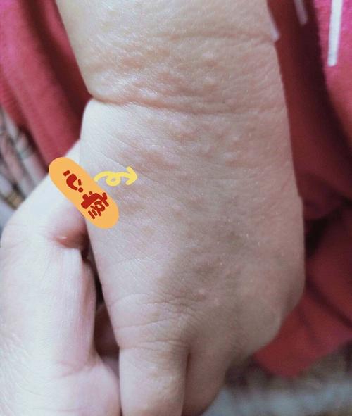 儿童神经性皮炎严重吗-第2张图片-郑州医学网