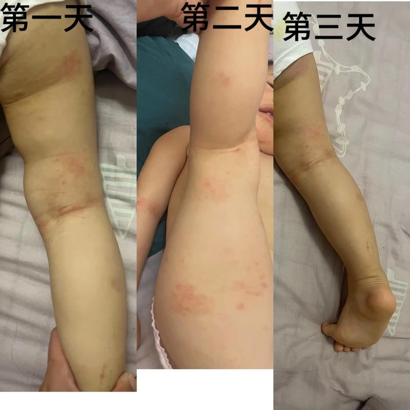 儿童也会得神经性皮炎吗？病因与家长该如何科学应对？-第3张图片-郑州医学网