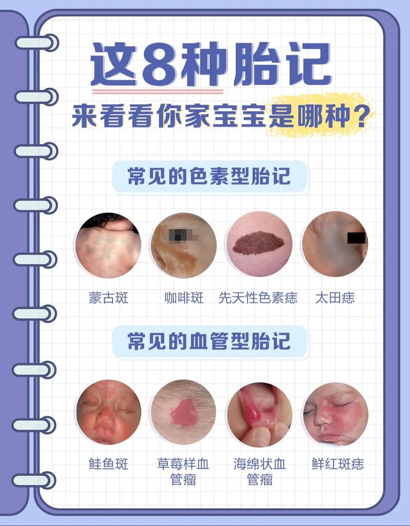 新生儿胎记形成的原因-第1张图片-郑州医学网