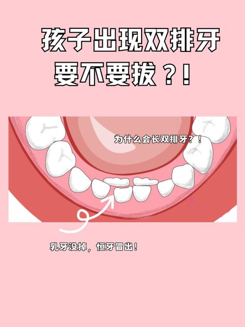 6岁儿童长双排牙是正常现象吗？需要拔牙干预吗？如何正确处理？-第2张图片-郑州医学网