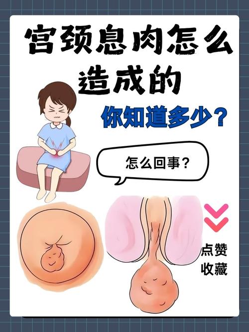 孕期怎么检查宫颈息肉-第2张图片-郑州医学网