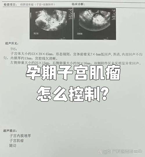 孕期肌瘤生长如何科学抑制？有哪些安全有效的干预方法？-第3张图片-郑州医学网