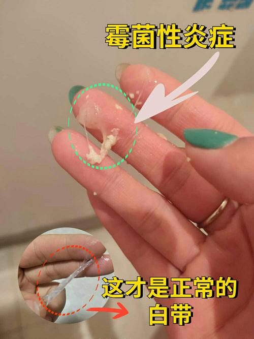 孕期白带检查出霉菌，对胎儿有影响吗？需要怎么治疗才安全？-第3张图片-郑州医学网