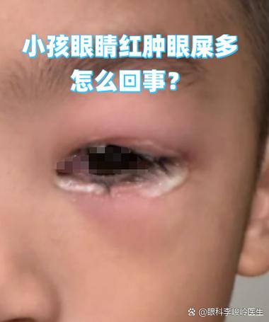 新生儿泪囊炎和结膜炎如何区分？护理上要注意什么？-第1张图片-郑州医学网