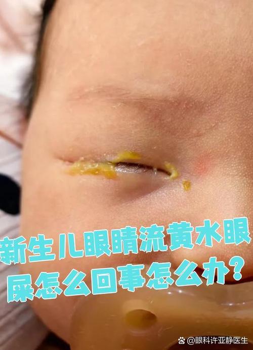 新生儿泪囊炎和结膜炎如何区分？护理上要注意什么？-第3张图片-郑州医学网