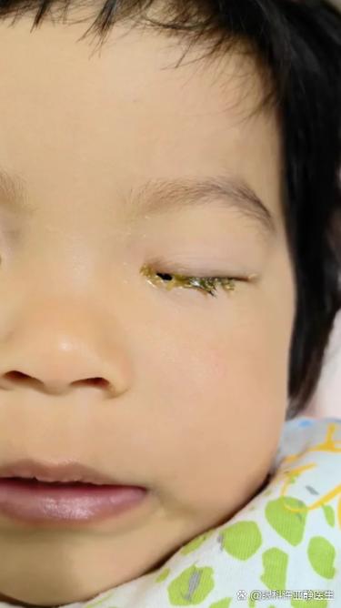 新生儿泪囊炎和结膜炎如何区分？护理上要注意什么？-第2张图片-郑州医学网