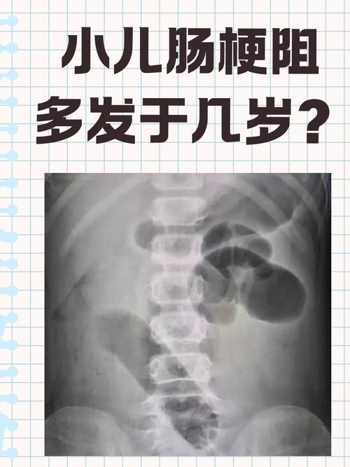 新生儿肠梗阻有哪些典型症状？家长该如何早期识别与应对？-第1张图片-郑州医学网
