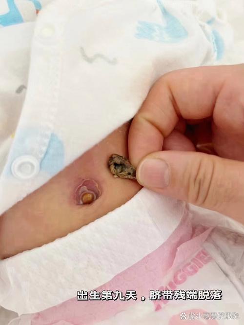 新生儿肚脐脱落前后护理要注意什么？图片中的正常状态该咋判断？-第1张图片-郑州医学网