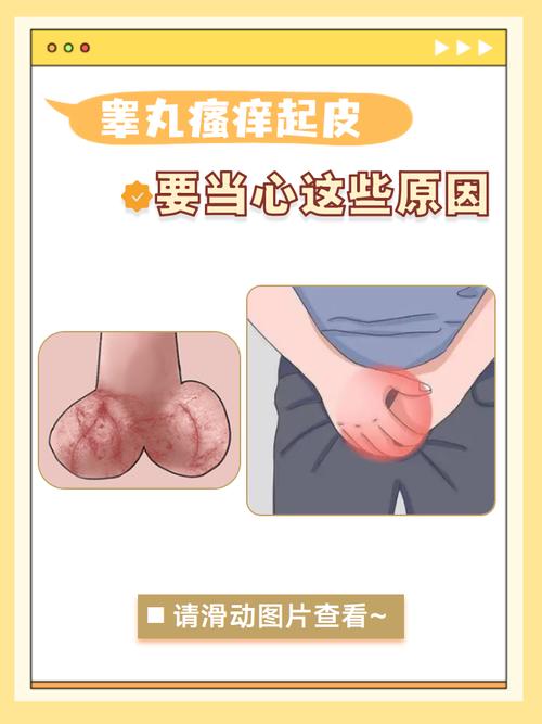 儿童阴囊湿疹反复发作怎么办？日常护理和用药要注意什么？-第1张图片-郑州医学网