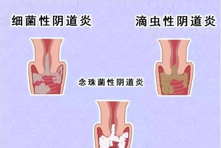 孕期外阴肿痛难缓解？原因与安全应对方法有哪些？-第2张图片-郑州医学网