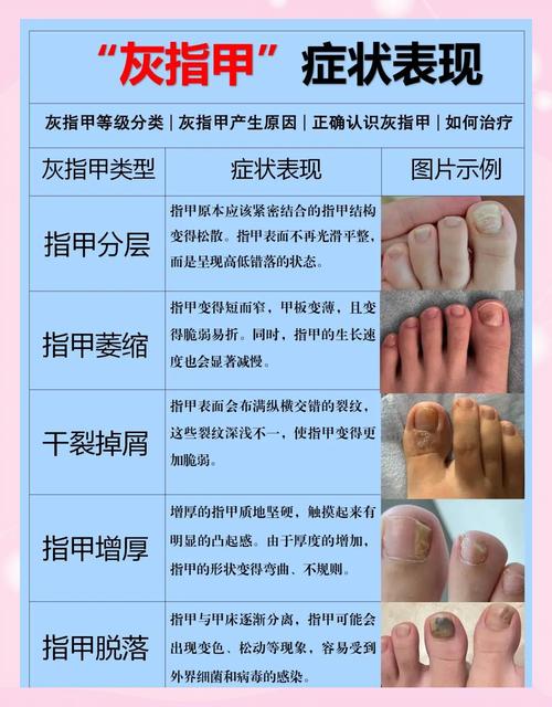 怀孕期间灰指甲怎么办-第2张图片-郑州医学网