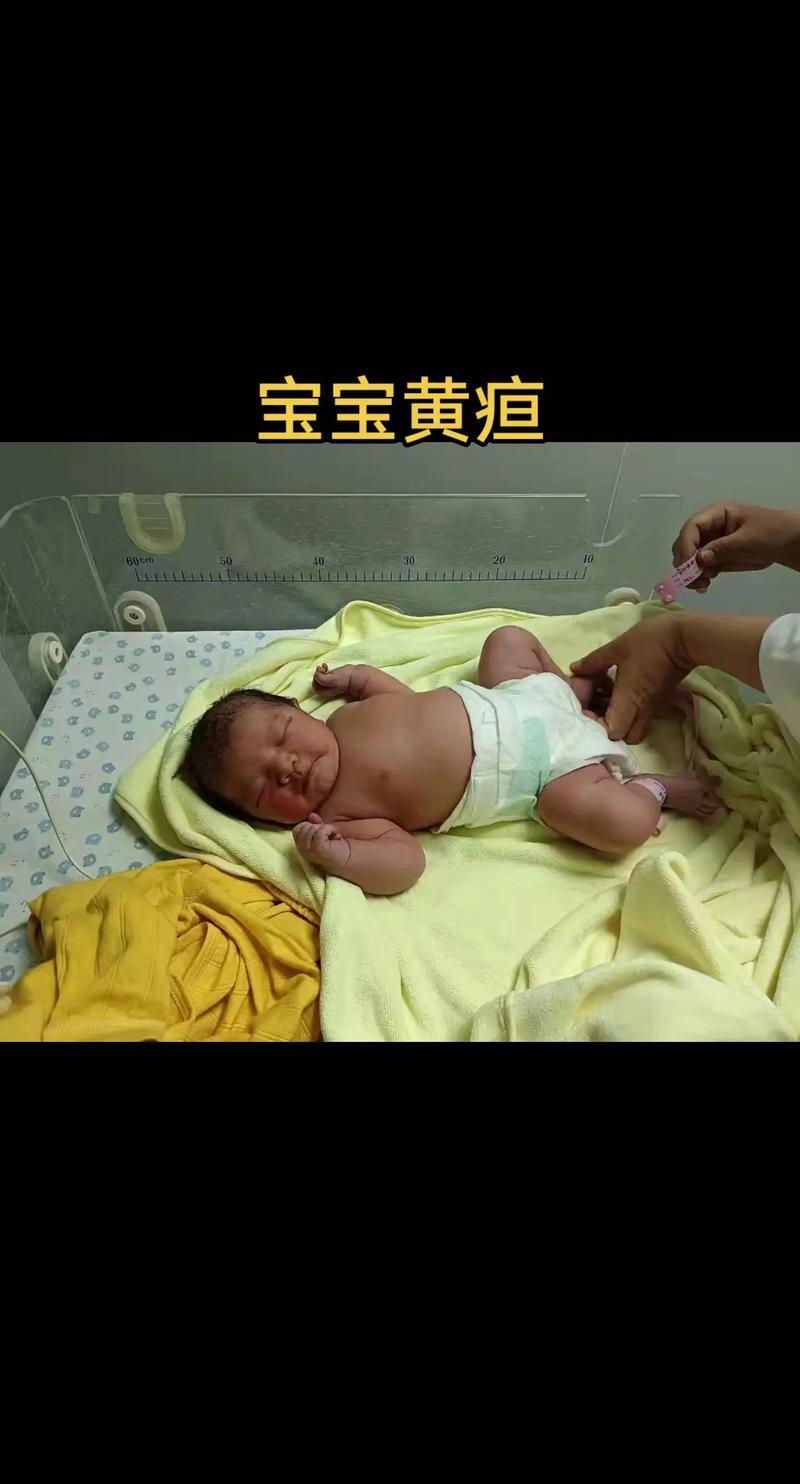 新生儿6天黄疸值18mg/dl需要立即干预吗？会对脑部有影响吗？-第3张图片-郑州医学网