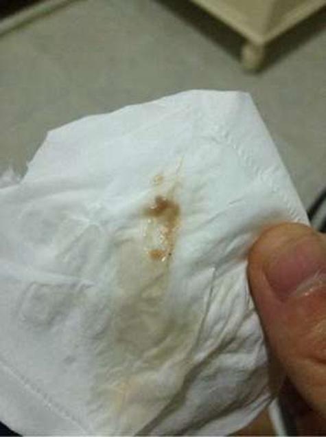 怀孕期间白带呈咖啡色是正常现象还是异常信号？-第2张图片-郑州医学网