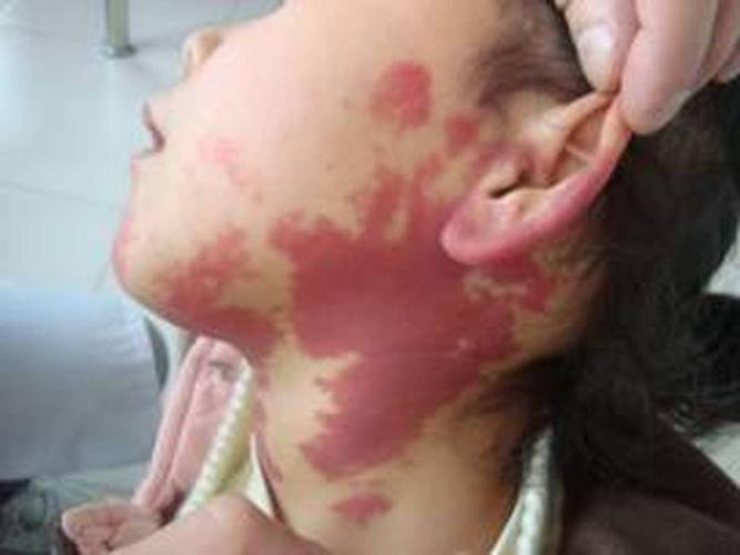 新生儿斑痣和鲜红斑痣有何区别？需要治疗吗？-第1张图片-郑州医学网