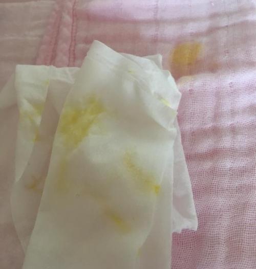 新生儿吐奶吐的是奶瓣-第2张图片-郑州医学网